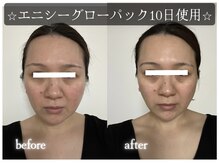 アルゴ 春日那珂川店(ALGO)の雰囲気（高機能炭酸ガスパック【エニシーグローパック】正規品導入店舗☆）