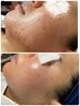 【韓国式肌荒れ徹底改善コース】キャンペーンクリスタルフォトケア¥6980