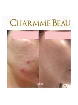 アリス(Alice)/シャルムボー正規取扱店