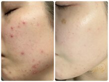 リリー(Rily)の雰囲気（「やって良かった！」をお約束★自信を持って素肌を出せる自分に）
