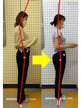 ひよこ整骨院/骨盤矯正Before→Ａfter