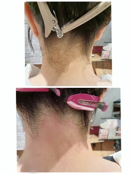 プトゥリ(Putri)/うなじ脱毛