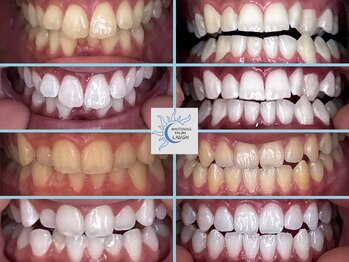 ラフ(LAUGH)/【審・美・白】 ホワイトニング