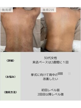 サロンエヌ 久留米店(Salon N)/くすみ/ニキビケア