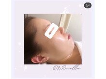 オアジスパ(Oasi Spa)/ハイドロキノン×レチノール