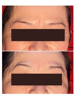 ヴィズコレクトビューティ(VIZ CORRECT BEAUTY)/水素パック1回目