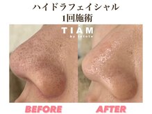 ル ポム バイ ティアム 神戸元町(Le pom by TIAM)/毛穴洗浄