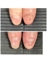 ウェルズユキ(well's yuki)/自爪育成（噛みつ爪）