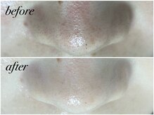 アンドナイン エス店(ANDNINE.)/◆毛穴洗浄　1回