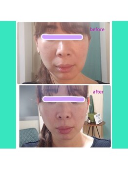 シンシア(sincere)/サーマクール★小顔/肌管理