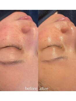 リーミー(Re:me)/★赤み/乾燥肌もお任せ下さい★