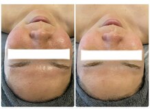 エヌ(enu)/ハーブピーリング/フェイシャル