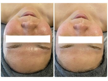 エヌ(enu)/ハーブピーリング/フェイシャル