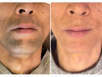 レジーナビューティー(Regina Beauty)/ヒゲ脱毛のビフォーアフター