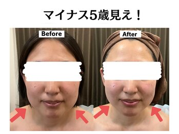 グレースティー 森町 箕面/顔が上がる！リフトアップ★