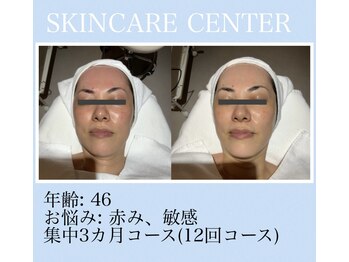 アンジェラックス スキンケアセンター心斎橋/46歳　赤み鎮静ケア