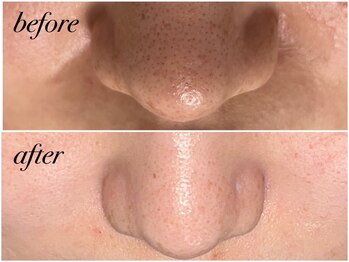 アンドナイン エス店(ANDNINE.)/◆毛穴洗浄 1回