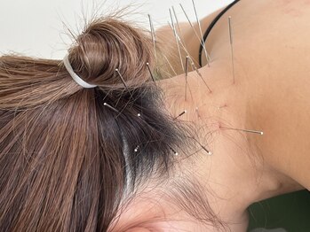 耀 カガヤキの写真/〈慢性的疲労/頭痛/めまい〉でお悩みの方にも◎頭・顔の鍼でサクッと改善へ！終わったあとはスッキリ爽快◎