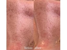 リーミー(Re:me)/★毛穴黒ずみが出来ないお肌へ★