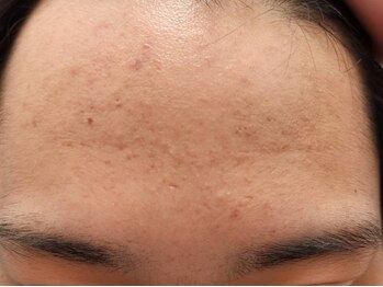 クレエ(Cre’er)の写真/メンズの肌管理にオススメ★【肌質改善へ】ニキビケア☆肌荒れを軽減！￥4,000→￥3,000