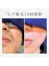 ボゴス(BOGOSS)/ヒゲ脱毛15回照射