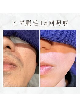 ボゴス(BOGOSS)/ヒゲ脱毛15回照射