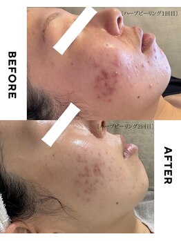エステサロン アンジュール(Angelle)/ハーブピーリングbefore after