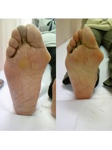 同心整体院/タコ、魚の目除去