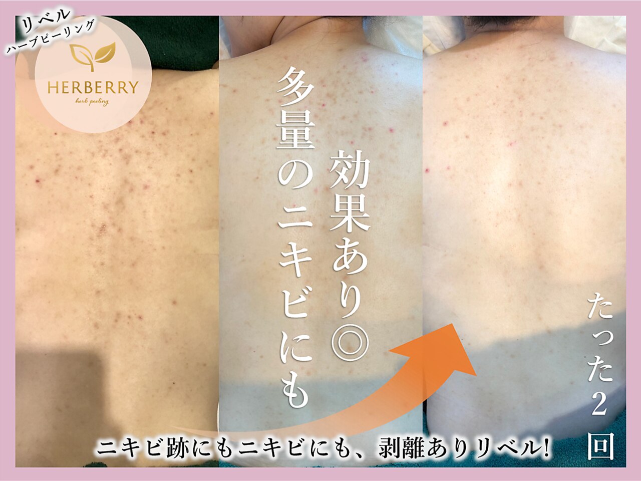 ハーバリー ハーブピーリング 大阪梅田店(HERBERRYハーブ ハーバリー ハーブピーリング 大阪梅田店(HERBERRYハーブ