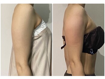 OBS/極細二の腕・ブライダル