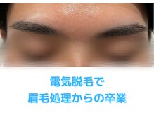 メンズフェイス 刈谷店/電気脱毛