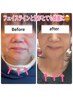 【口コミ掲載者限定】浮腫み改善・リフトアップ小顔矯正コース7000円税込40分