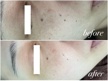 アンドナイン エス店(ANDNINE.)/◆毛穴洗浄+ハーブピーリング1回