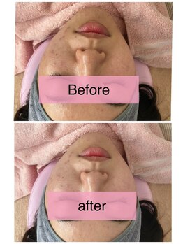 アスピリア(aspirer a')/ハーブピーリング