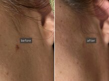 SEC(Shizuoka esthetic company)/【シミ改善】スポットケア♪