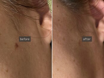 SEC(Shizuoka esthetic company)/【シミ改善】スポットケア♪