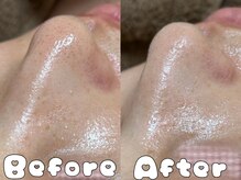 グラシア 倉敷店(Gracia)/ハイドラ毛穴洗浄