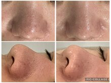 エメ 心斎橋(Aimer)の雰囲気(お手入れの定番!『毛穴洗浄』一度でも満足できる結果です☆)