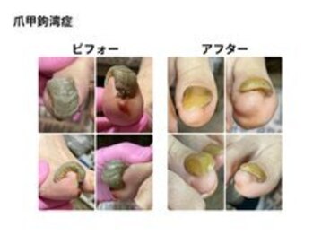 巻き爪補整店 桜庵の写真/巻き爪補整が初めてでも安全に配慮した丁寧な施術で不安を軽減