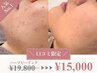 期間限定ハーブピーリング￥19800→￥15000/ニキビ/皮脂トラブル/毛穴悩みに◎