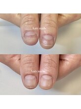 アーティネイルズ(Aaty Nails)/【深爪矯正】ハンド