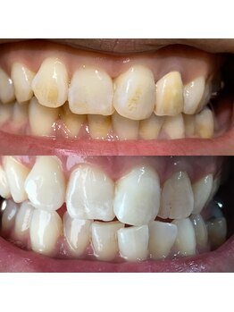 ティースクリーン(Teeth Clean)/セルフホワイトニング12回