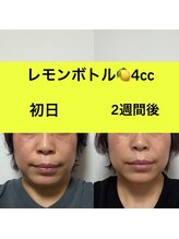 ララチッタ(L'la citta)/レモンボトル4cc