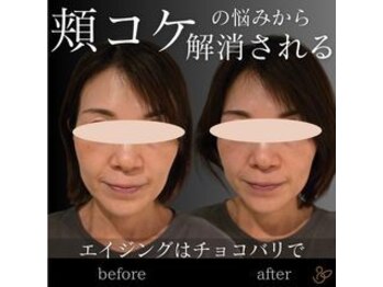 チョコバリ 郡山店(chocobari)/小顔×リフトアップ(美容鍼)30代