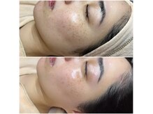 毛穴のざらつき解消・肌のトーンアップ・産毛がスッキリ♪