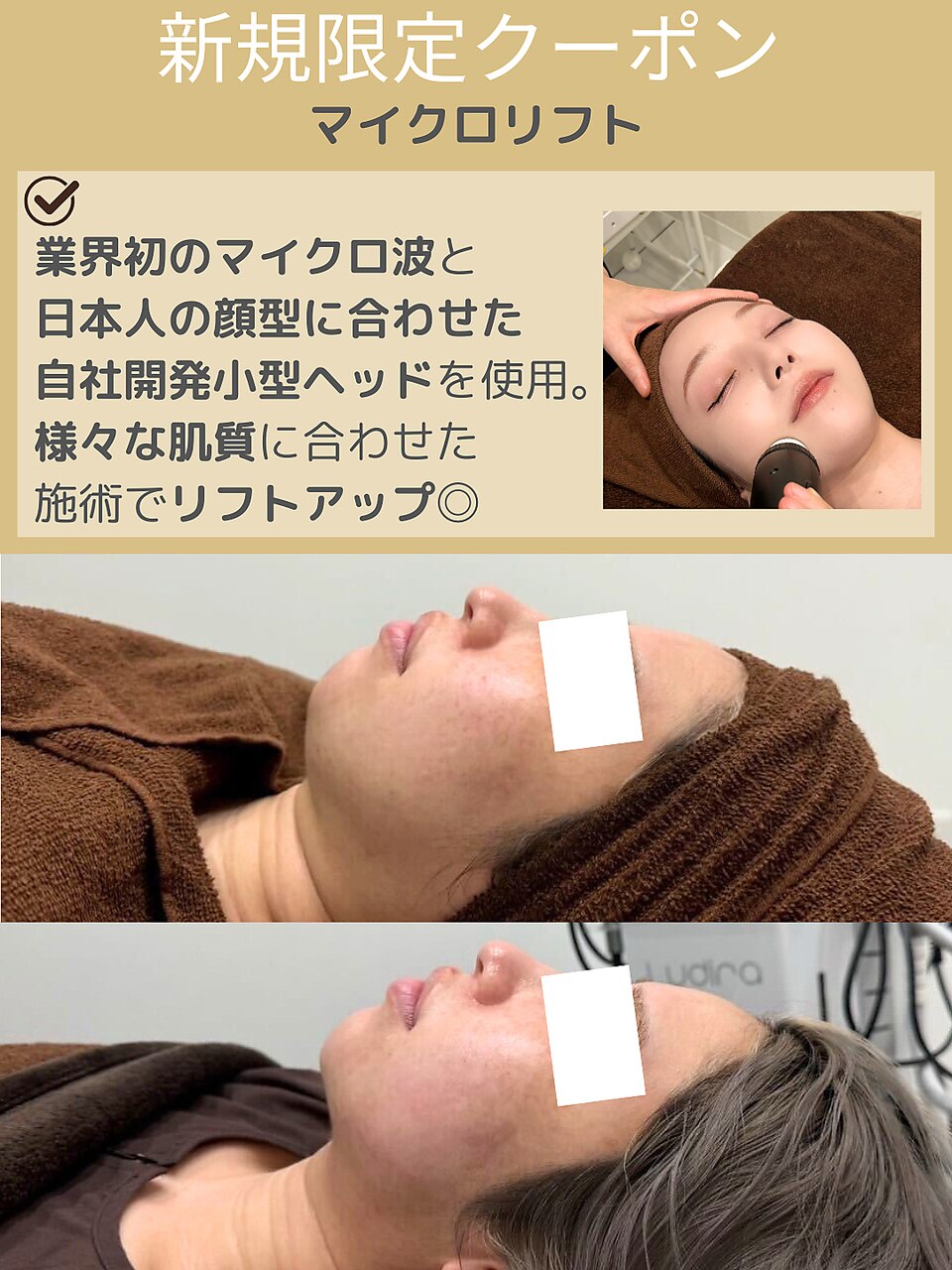 【お顔の脂肪撃退☆】ダウンタイムなし◎マイクロ波リフトで最新小顔¥13000