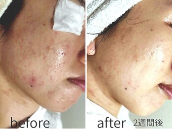 カヌヌ(kanunu)/光フォト/ニキビケア