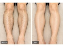 サロン スムース(Salon SMOOOTH)/足脱毛のお客様のビフォアフ