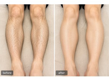 サロン スムース(Salon SMOOOTH)/足脱毛のお客様のビフォアフ
