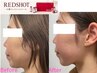 人気No.2【顔のお肉・二重あご】脂肪分解レッドショット×オーダーメイド小顔